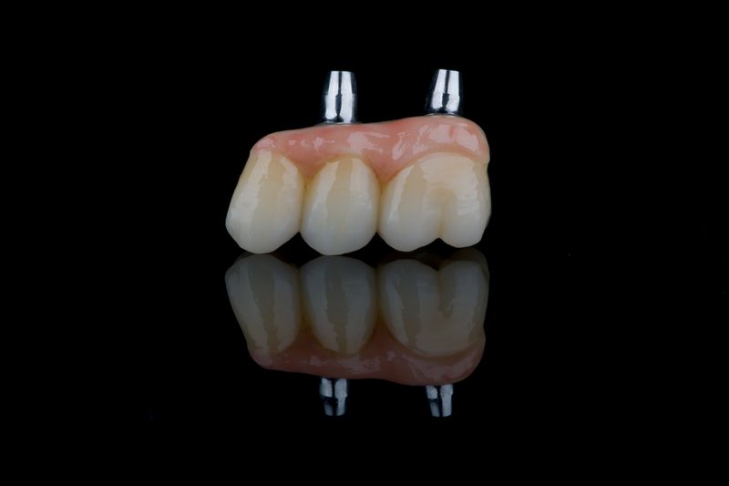 All-ceramic implant crown — zirconia on implant Sydney